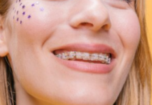 Комфорт і практичність керамічних брекетів