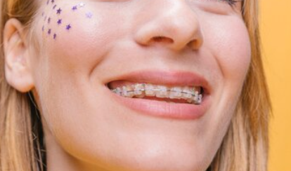 Комфорт і практичність керамічних брекетів